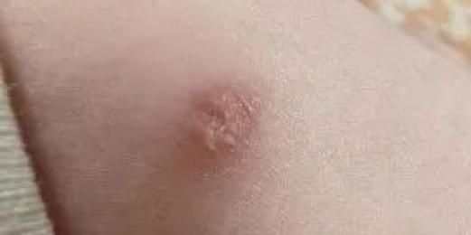 预防接种知识问答
