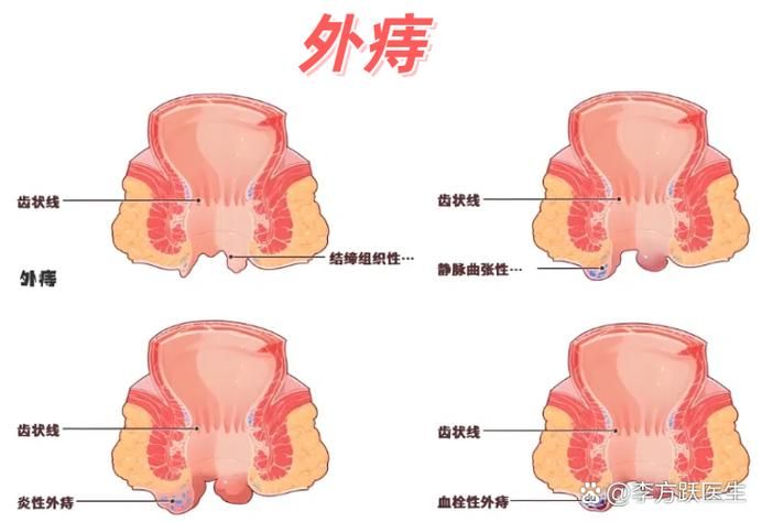 How much for mixed hemorrhoid surgery