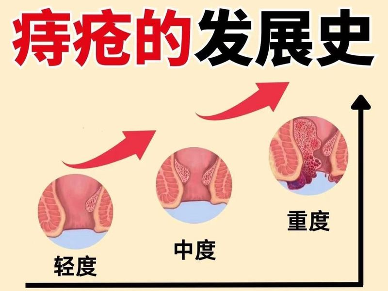 How much for mixed hemorrhoid surgery