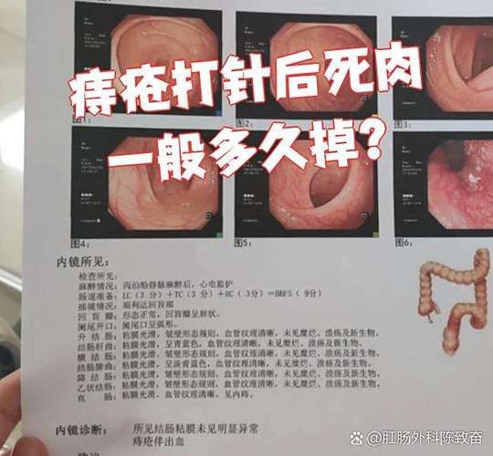 混合痔疮手术多少钱