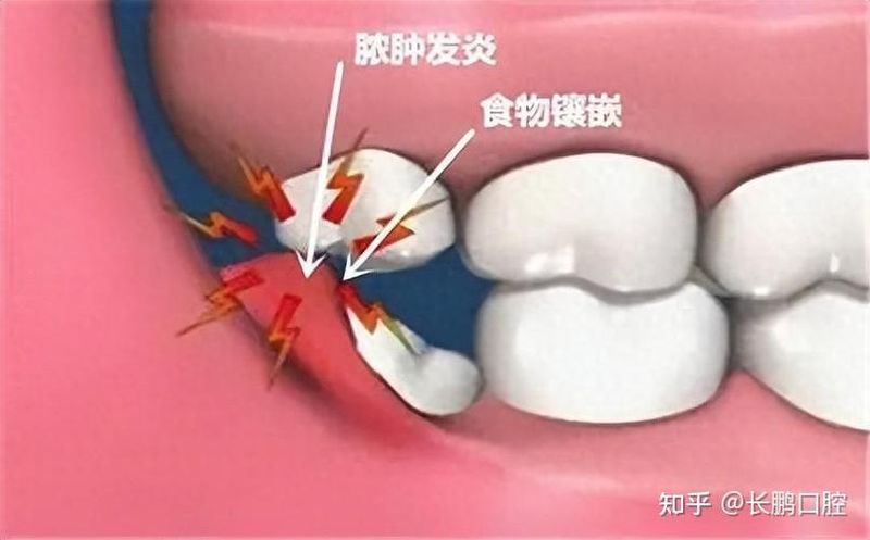 拔牙龈里面的智齿多少钱