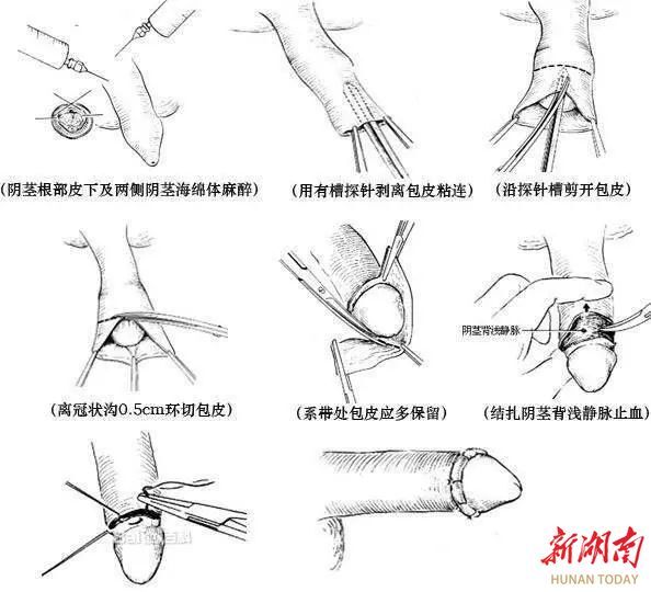 大连包皮手术多少钱