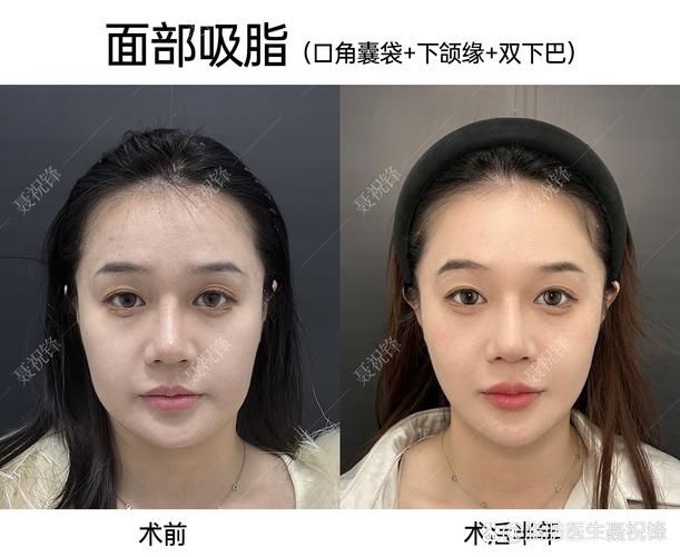 吸脂减肥价格 吸脂手术多少钱