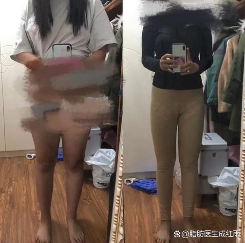 吸脂减肥价格 吸脂手术多少钱