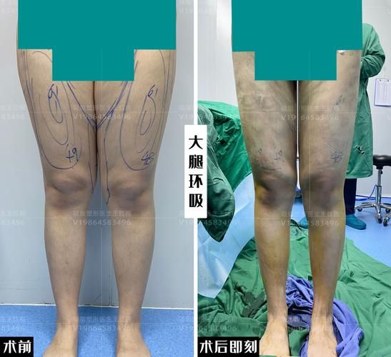 吸脂减肥价格 吸脂手术多少钱