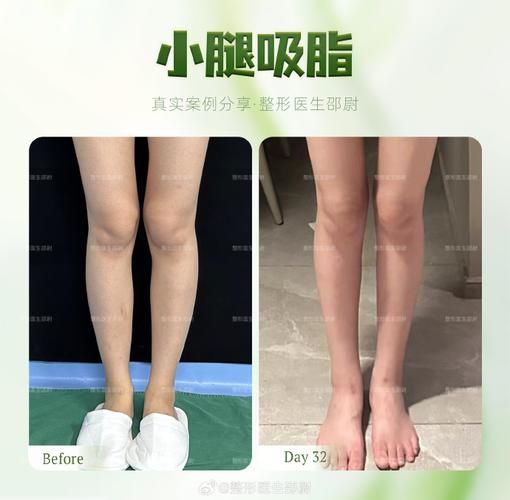 吸脂减肥价格 吸脂手术多少钱