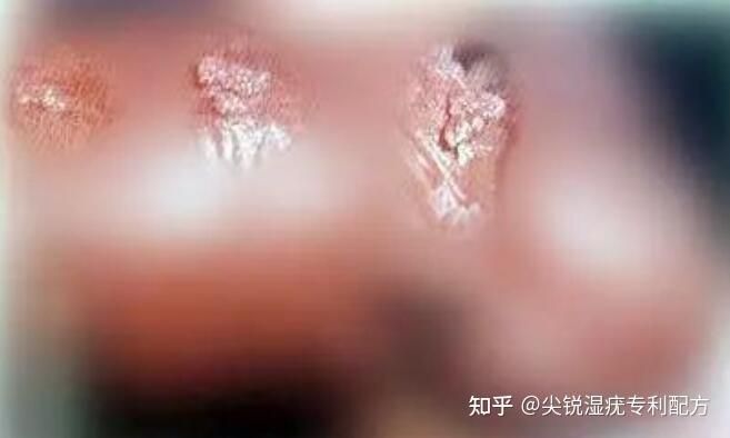 尖锐湿疣怎么治和费用山西