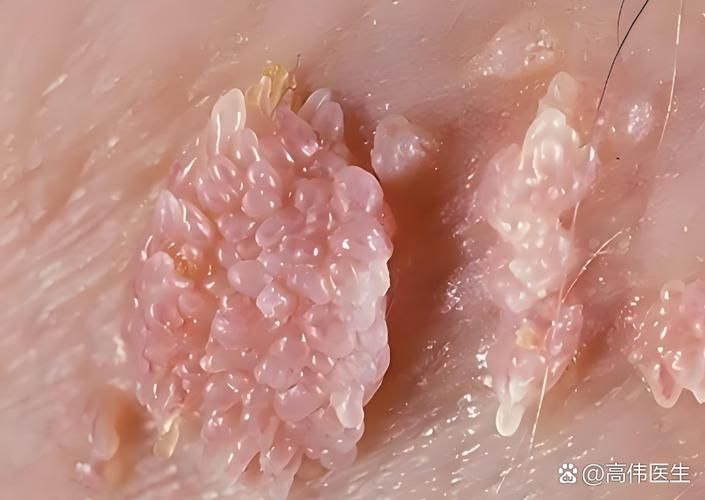 尖锐湿疣怎么治和费用山西