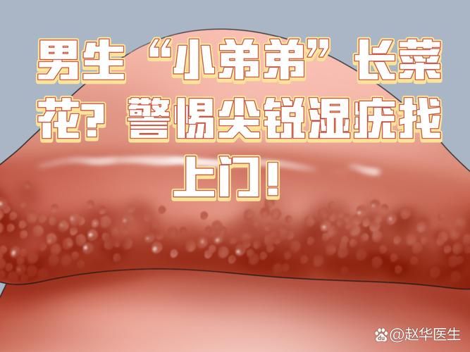 尖锐湿疣怎么治和费用山西