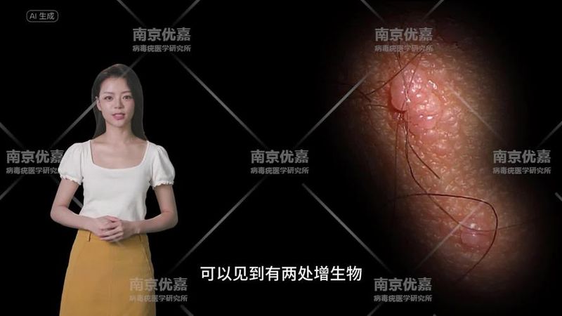 尖锐湿疣怎么治和费用山西
