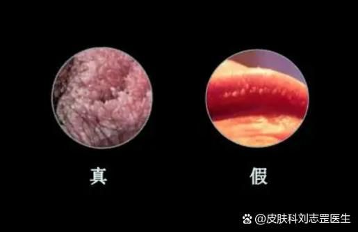 尖锐湿疣怎么治和费用山西