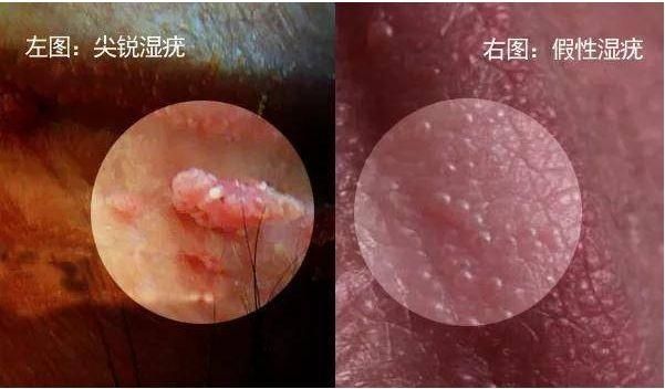 尖锐湿疣怎么治和费用山西
