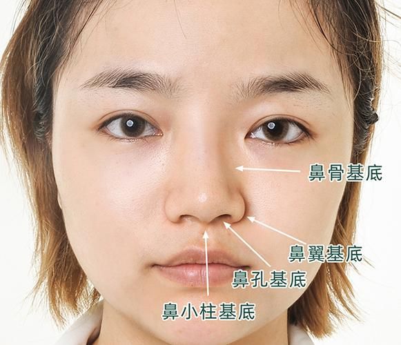 鼻翼肥大下垂费用