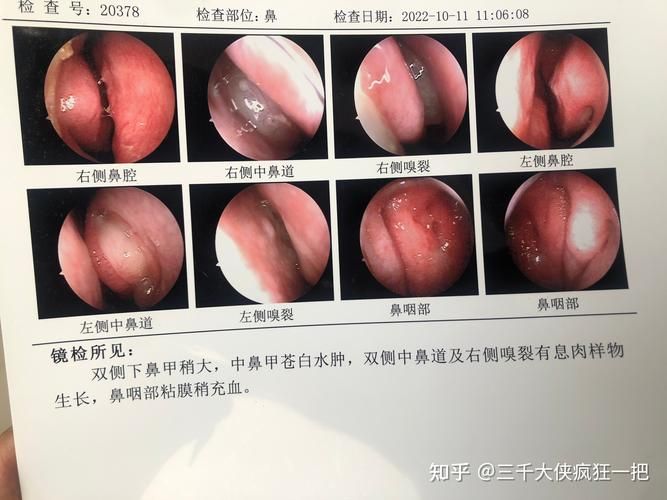 鼻窦炎手术 费用