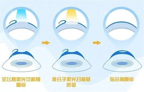 飞秒激光治疗近视费用
