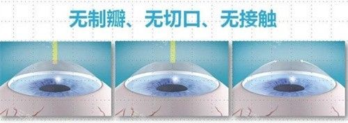 飞秒激光治疗近视费用