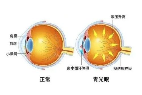 飞秒激光治疗近视费用
