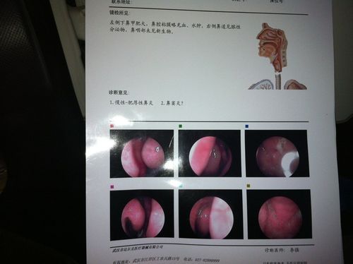 鼻窦炎手术 费用