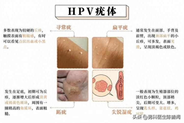 皮肤上的“不速之客”：带你认清各种HPV疣体