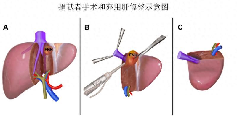 中大肝病医院治疗方法
