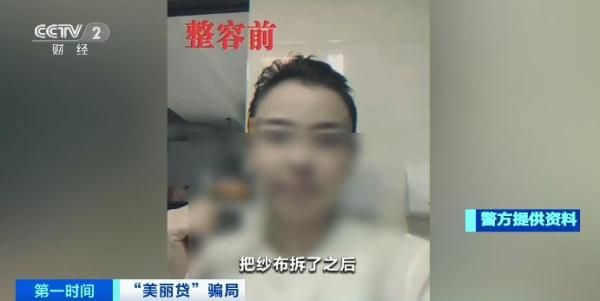 微整形瘦脸针多少钱