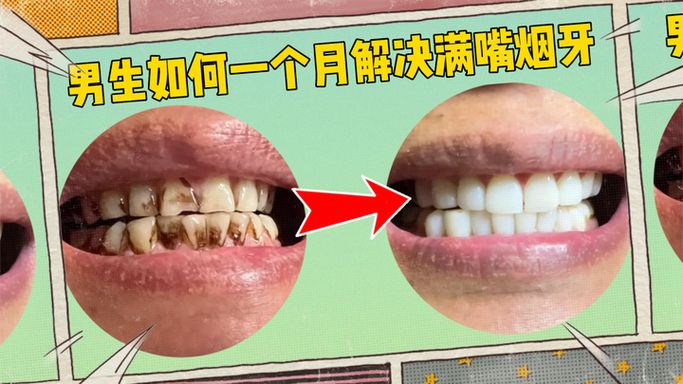 医院美白牙齿多少钱