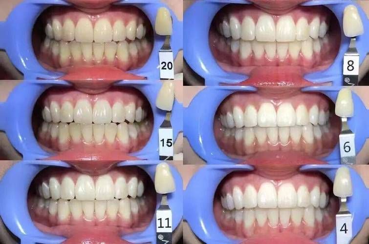 医院美白牙齿多少钱