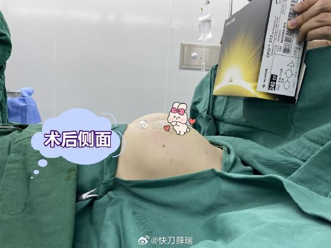 自体脂肪隆胸整形价钱
