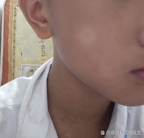 美国308准分子激光多少钱一台
