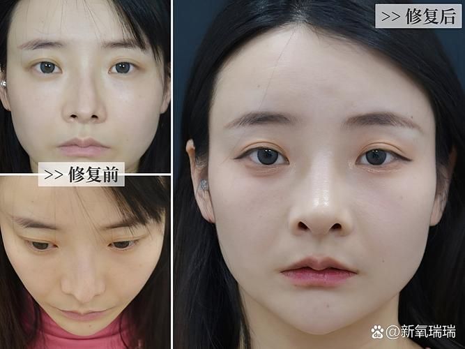 鼻翼缩小整形多少钱