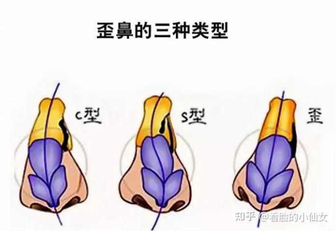 鼻翼缩小整形多少钱