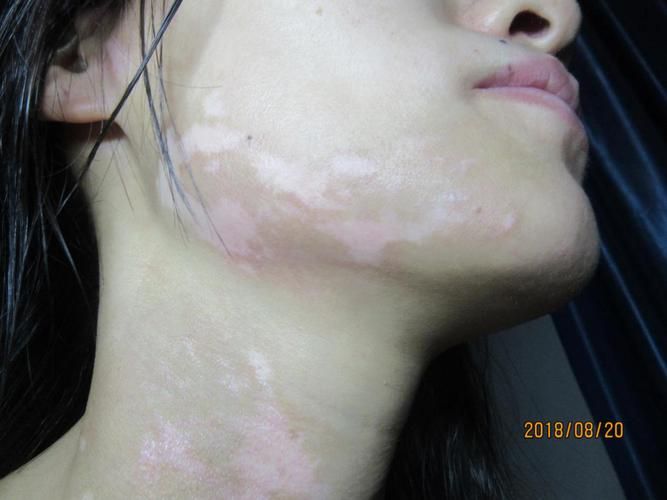 美国308准分子激光多少钱一台