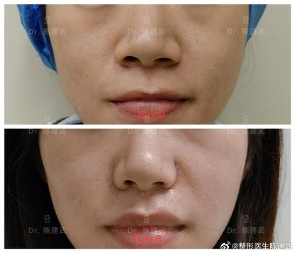 鼻翼缩小整形多少钱