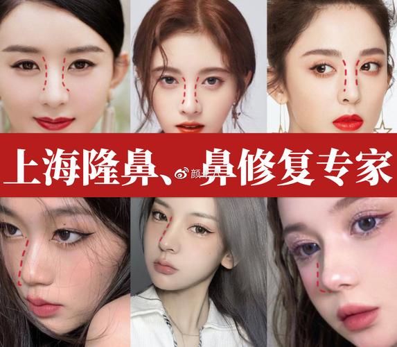 鼻翼缩小整形多少钱