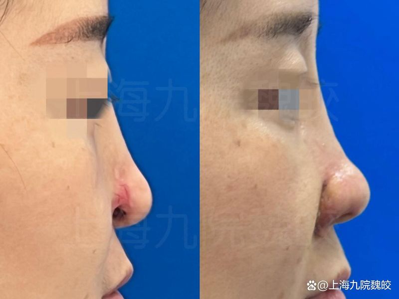鼻翼缩小整形多少钱