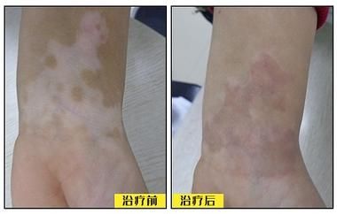美国308准分子激光多少钱一台