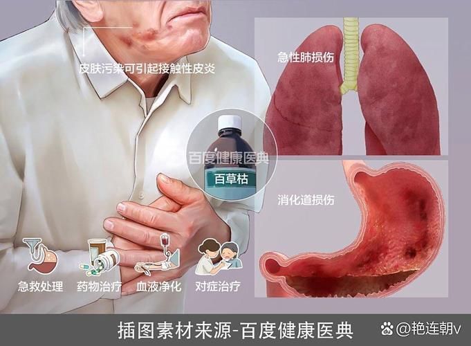 百草枯中毒机理