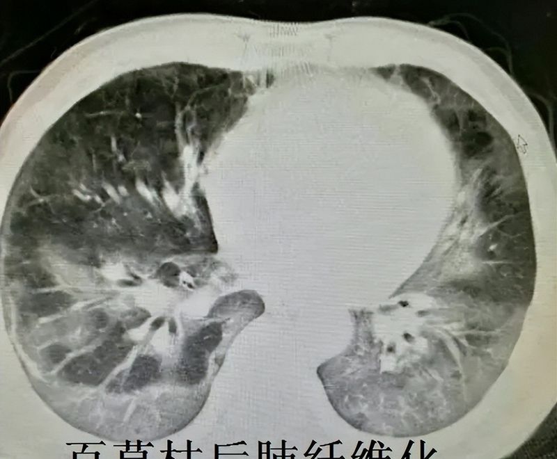百草枯中毒机理