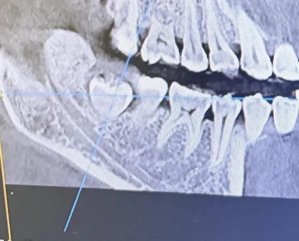 拔牙龈里面的智齿多少钱