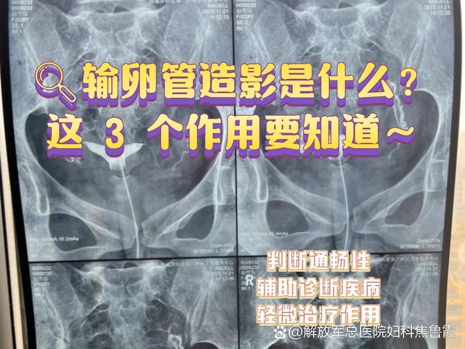 输卵管造影怎么做多少钱