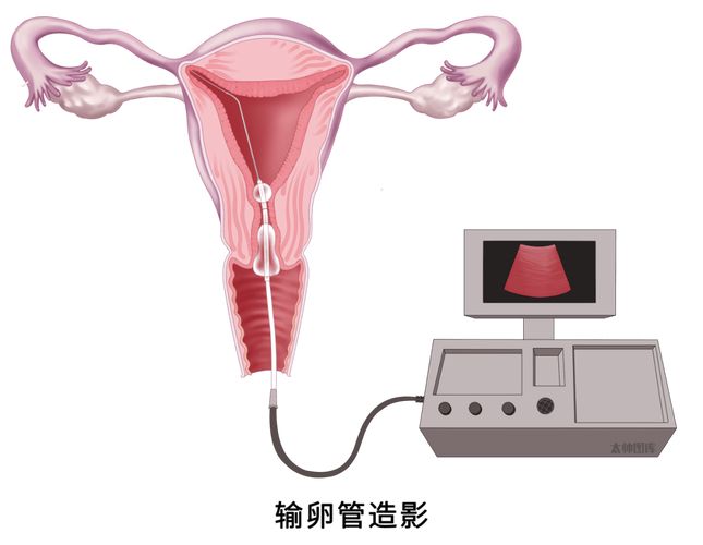 输卵管造影怎么做多少钱