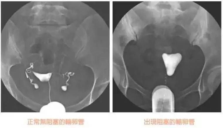 输卵管造影怎么做多少钱