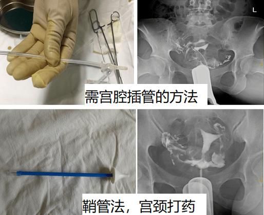 输卵管造影怎么做多少钱