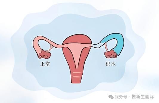 输卵管造影怎么做多少钱