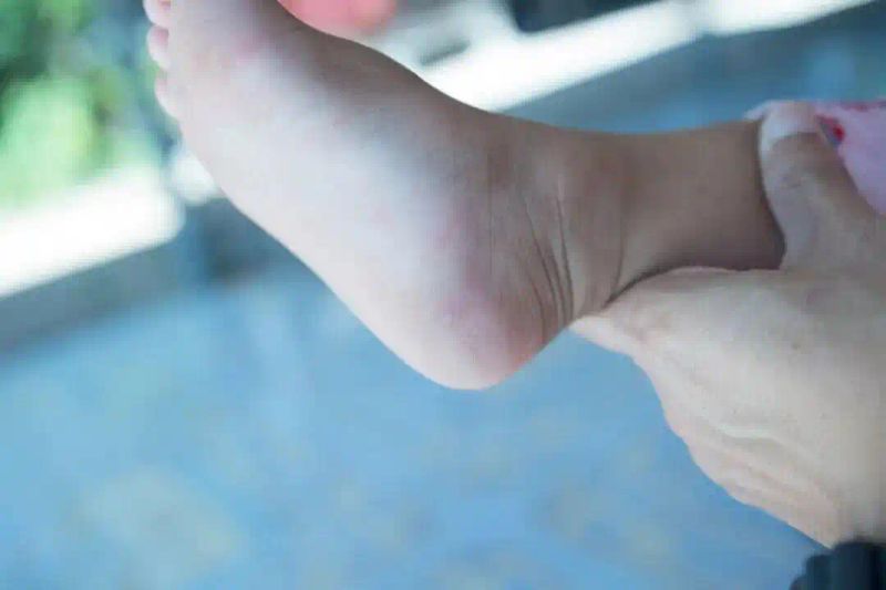 关于水痘的治疗方法