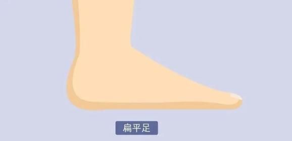扁平足的治疗方法