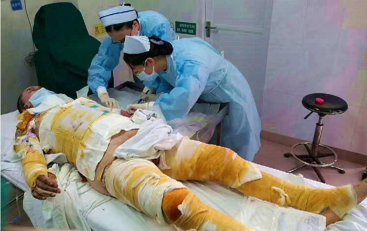 烧伤知识图片
