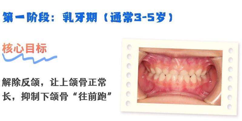 美容冠矫正地包天多少钱