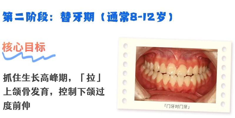 美容冠矫正地包天多少钱