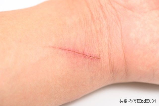 烧伤知识图片